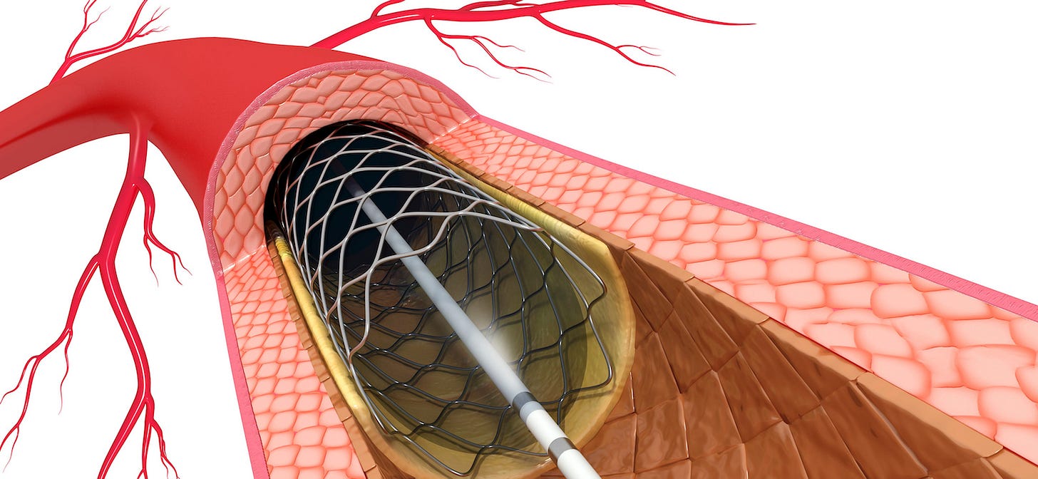 Percutaneous Coronary Intervention | Conditions & Treatments | UT  Southwestern Medical Center