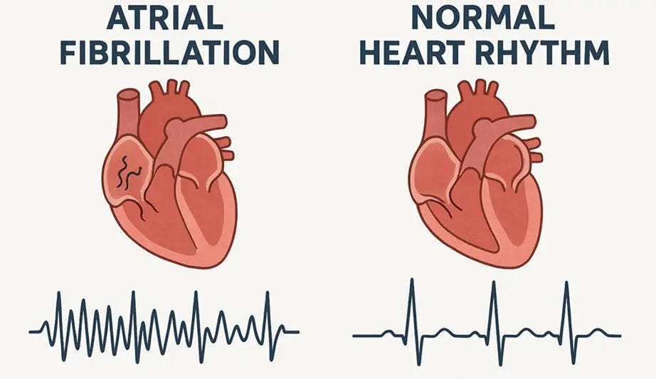 Side‑by‑side medical illustration comparing normal sinus rhythm with atrial fibrillation. The normal rhythm panel shows evenly spaced P‑QRS‑T waves, while the atrial fibrillation panel shows an irregular, chaotic baseline with absent P waves and irregular R‑R intervals