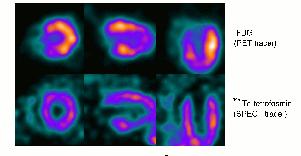 Nuclear medicine: 18F-FDG PET/CT for the detection of vaccine-induced pathologies