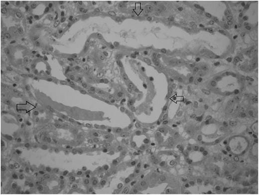 Renal biopsy showing revealed focal tubular injury with dilatation of tubular lumina and flattening of the tubular epithelial cells.