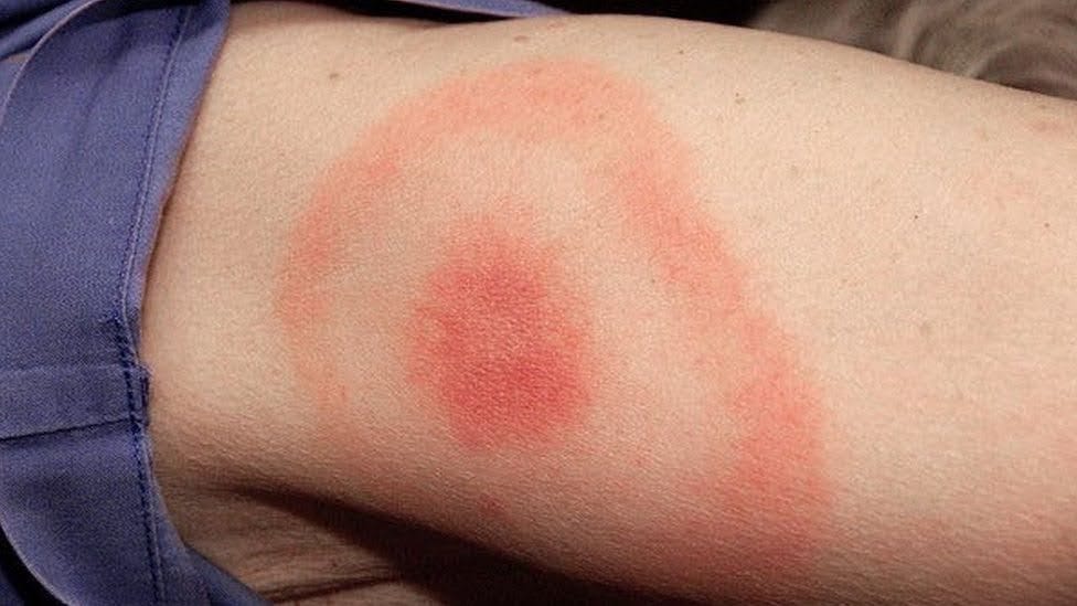 Lyme disease - description - by Will Taylor