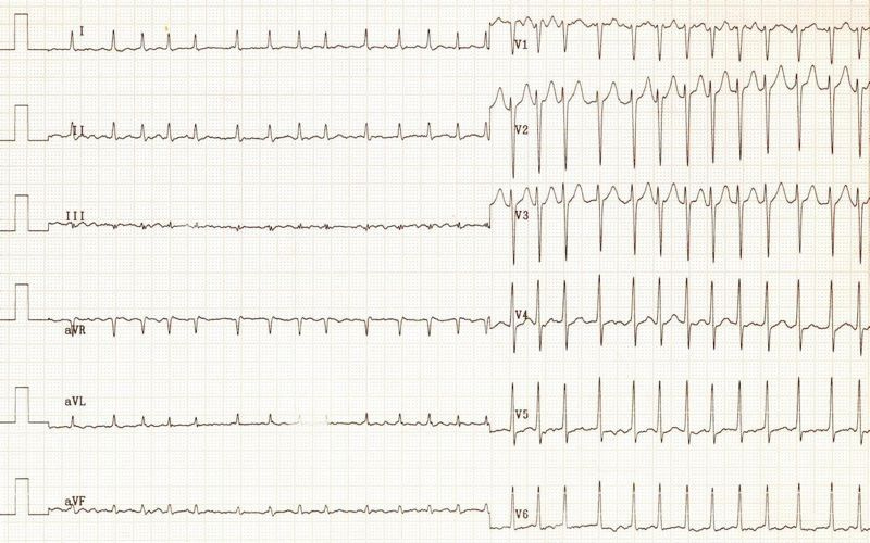 ECG ECG