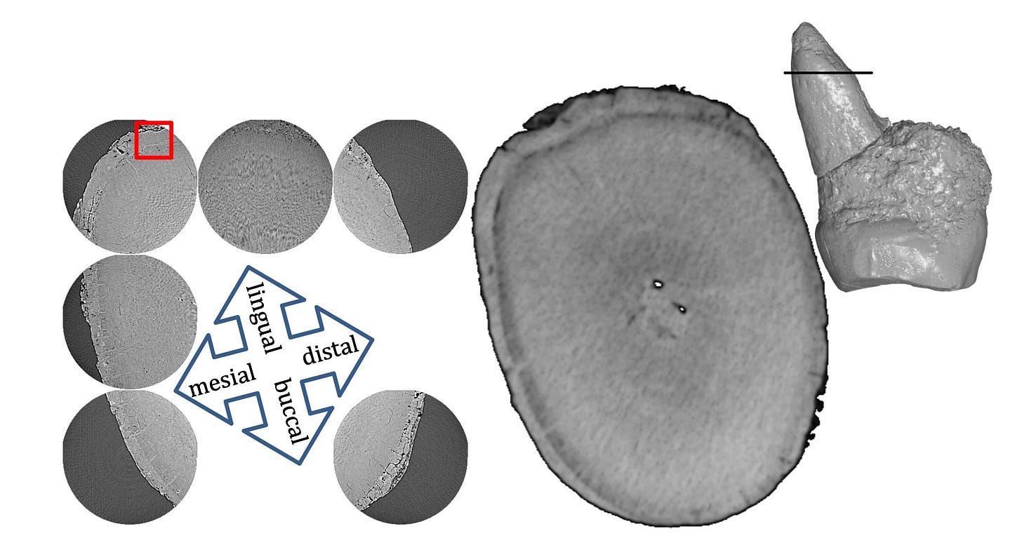 An image showing an enlarged cross-section of a tooth root, with insets showing the location of the cross-section on a tooth, and enlargements of the cementum at varied positions around the root's circumference An image showing an enlarged cross-section of a tooth root, with insets showing the location of the cross-section on a tooth, and enlargements of the cementum at varied positions around the root's circumference