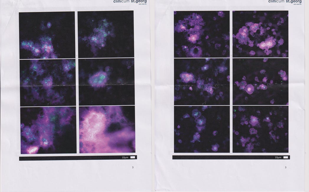 Microclots in Ungeimpften