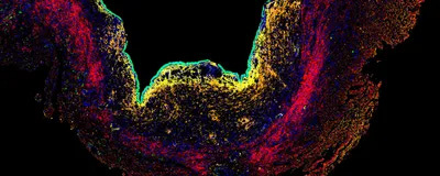 A microscopy image showing a cross-sectional view of endometriosis tissue with red, orange, yellow, and green colors against a black background.