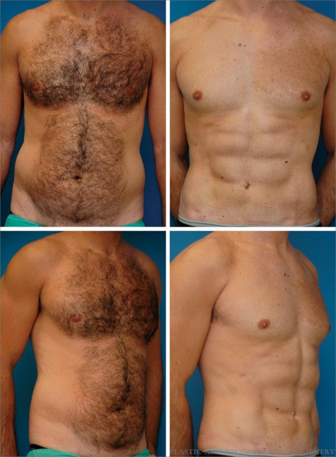Liposuction technique 'abdominal etching' grows in popularity despite $10k  price tag | The West Australian