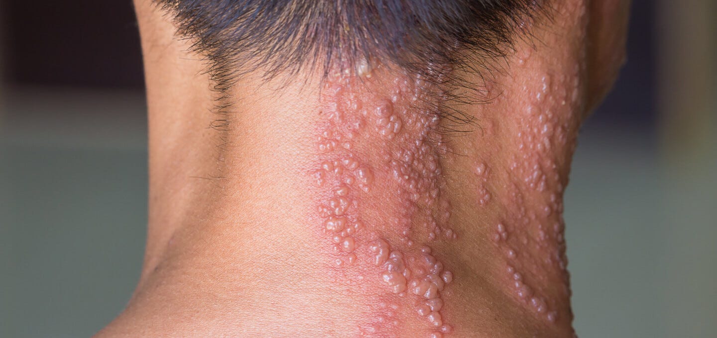 https://dermskinhealth.com/wp-content/uploads/2022/05/shingles-herpes-zoster-hero.jpeg
