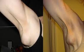 Left: right axillary lymphadenopathy prio to PDT, the swelling was... |  Download Scientific Diagram