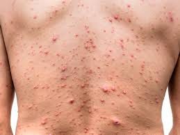 UK's oldest chickenpox patient died ...