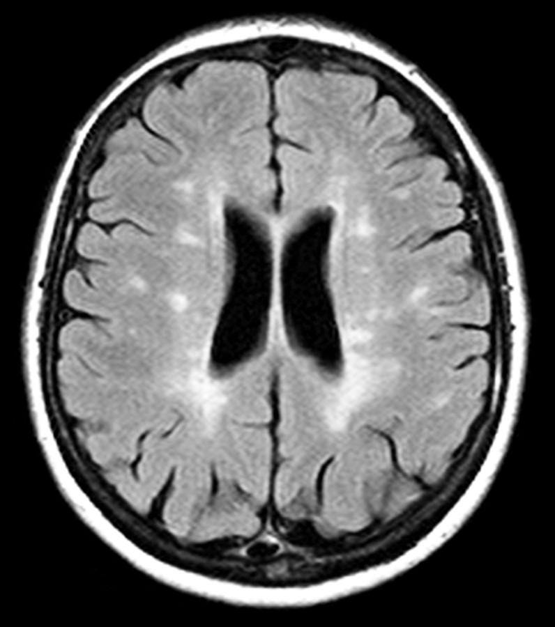 Multiple Sclerosis, Mri Scan Photograph by Du Cane Medical Imaging Ltd | Fine Art America