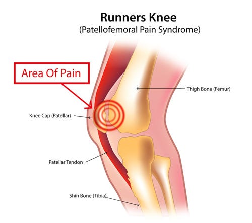 runners-knee-patellofemoral-pain-syndrome
