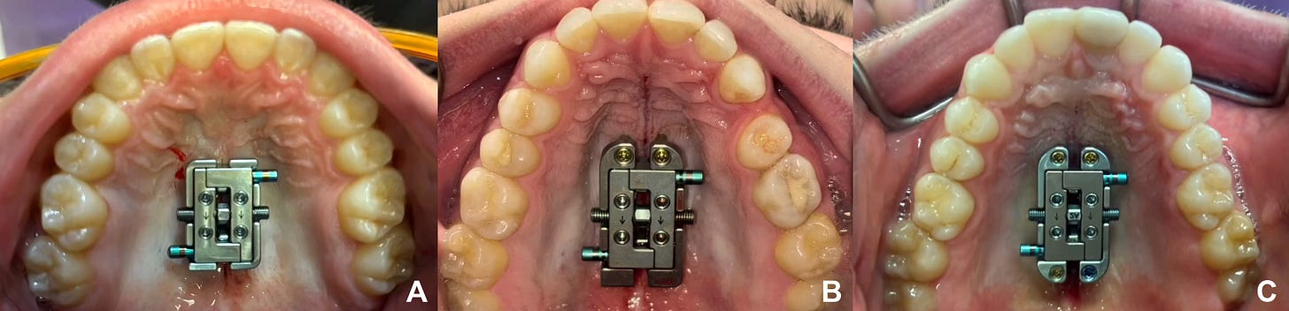 Tad Rpe 5.3 Top MARPE Devices Currently Available - JawHacks