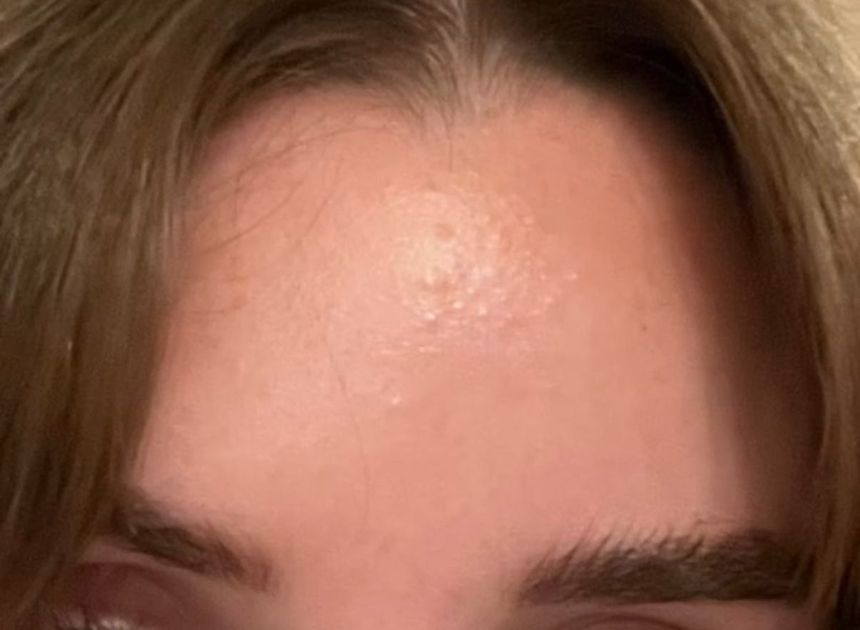 fungal acne 2024 My fungal acne when it first erupted last May 2024