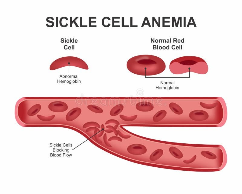 Sickle Cell Anemia Blood Cell Stock Image - Illustration of shape, healthy: 391905765 Sickle Cell Anemia Blood Cell Stock Image - Illustration of shape, healthy: 391905765