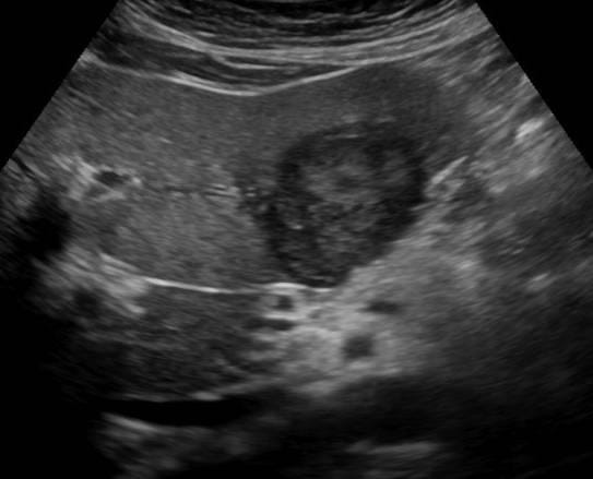 Abdomen and retroperitoneum | 1.1 Liver : Case 1.1.7 Hepatocellular carcinoma | Ultrasound Cases