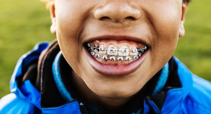 Straighten Your Smile | What Are Braces Used For?