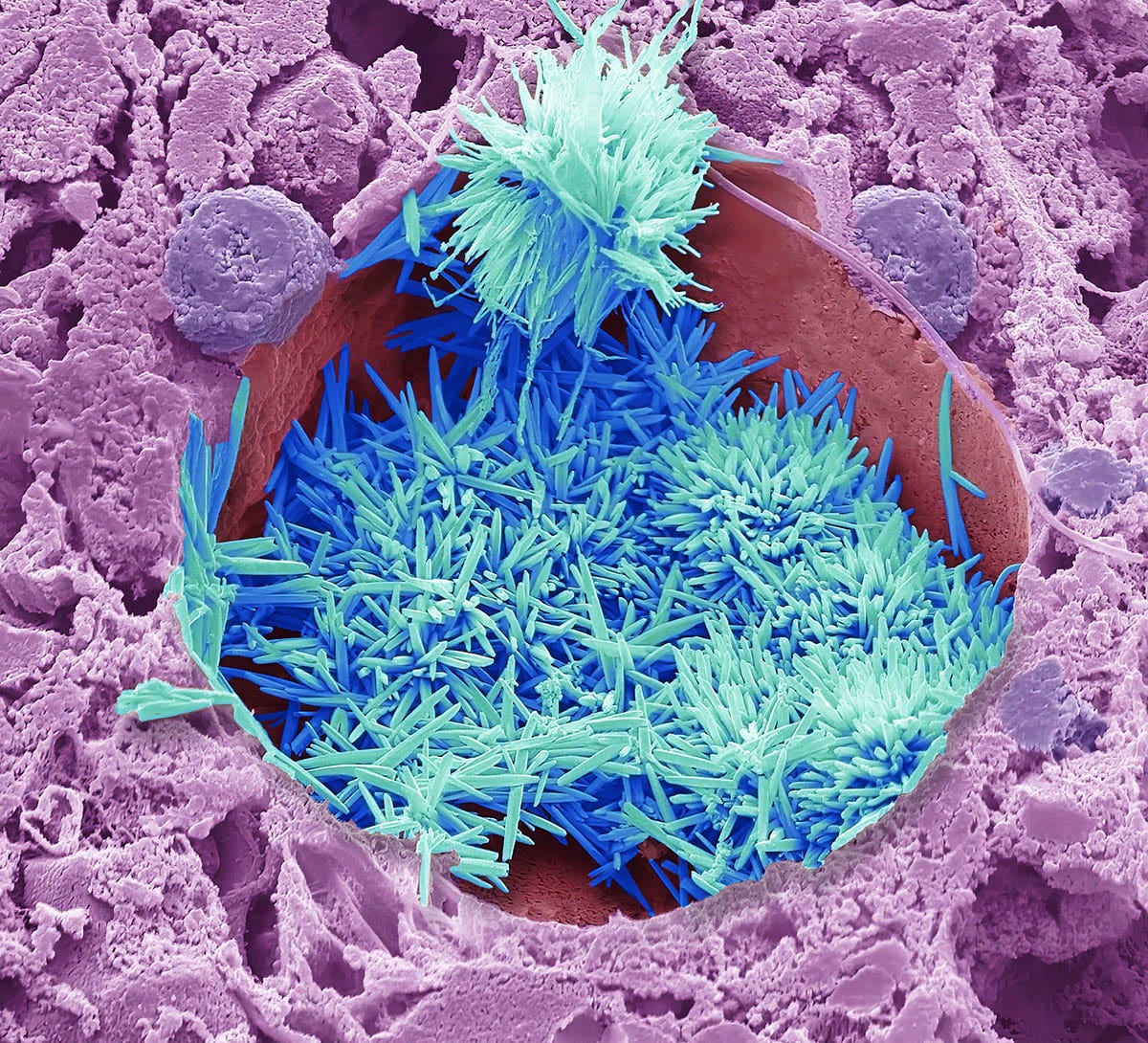 Cholesterol in the liver, an electron microscope image