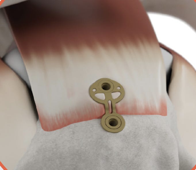 A close-up of a bone

AI-generated content may be incorrect.