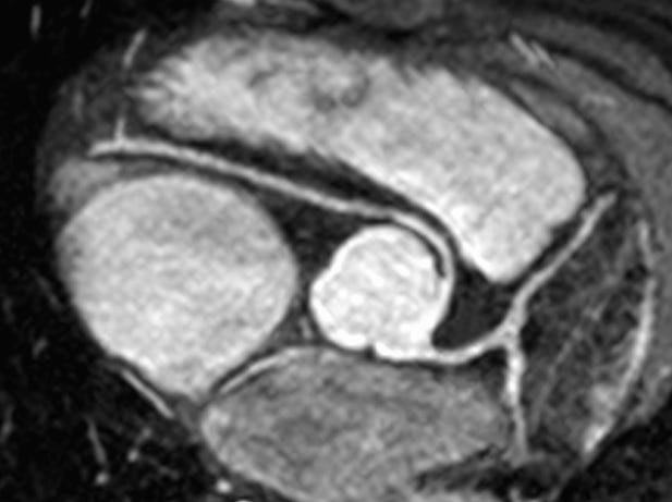 Anomalous aortic origin of a coronary artery - Wikipedia