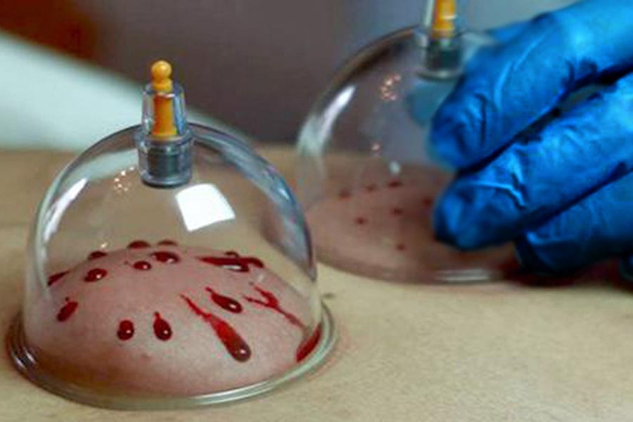 Hijama Cupping Therapy Kiya hai aur is k Faiyday? Roman Urdu main Parhain