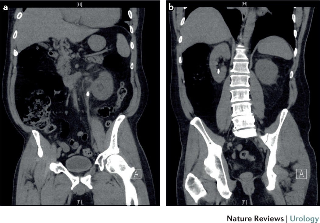 An overview of kidney stone imaging techniques | Nature Reviews Urology