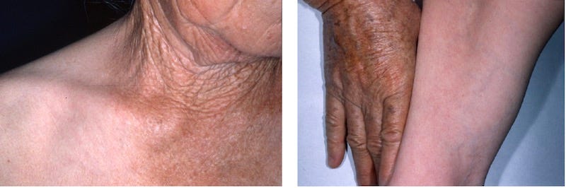 pele com fotoenvelhecimento, photoageing