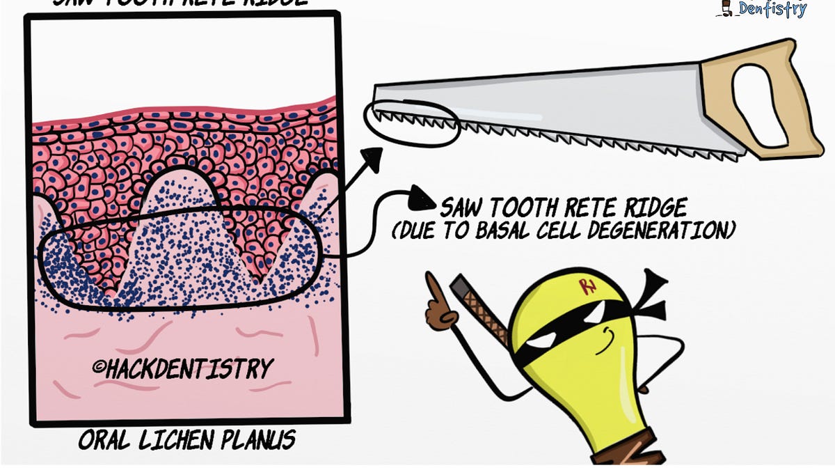 Drop Rete Ridges Common Histopathology terms - Highlights (Rete Ridges)