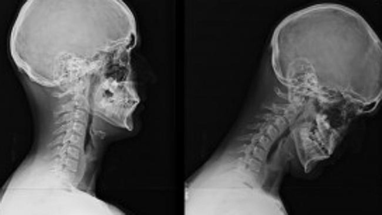 What is 'Text Neck' and How Do I Avoid It? - Exercise Right What is 'Text Neck' and How Do I Avoid It? - Exercise Right