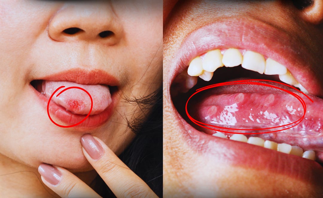 Herpes Na Lingua Foto