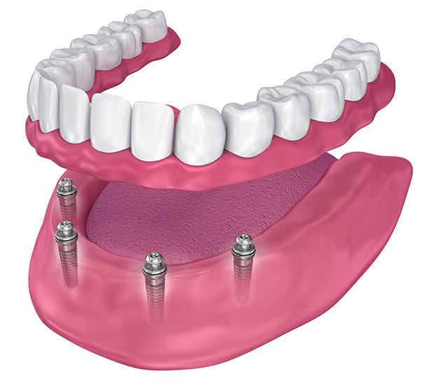 Burbank All-on-4 Implants Burbank All-on-4 Implants