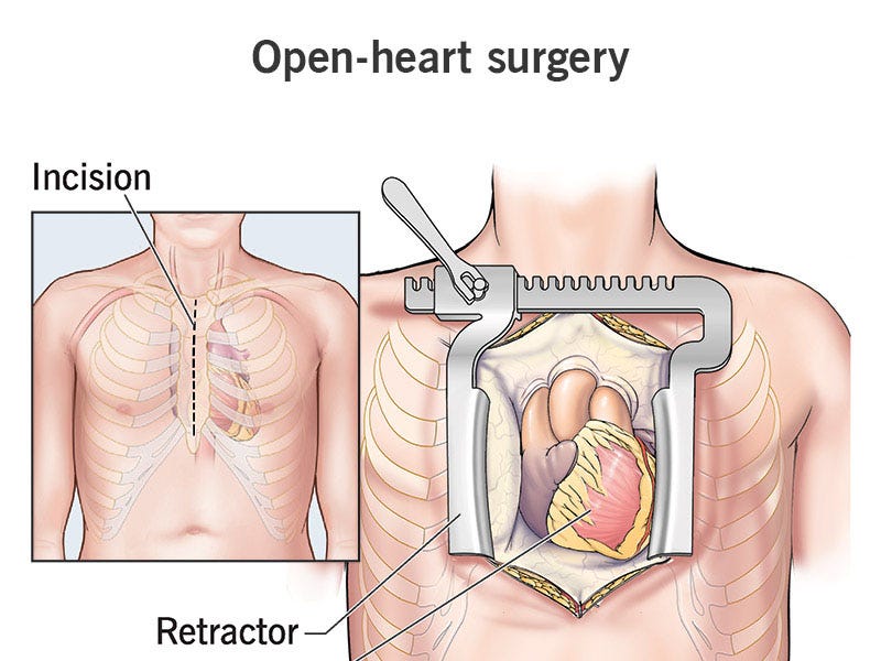 Open Heart Incision Closure Mesh The Process of Open-Heart Surgery - MEDILOQUY BLOG