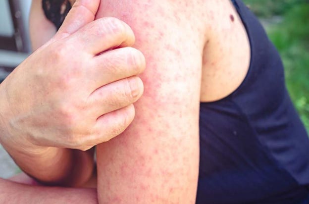 A person with a rash on their arm

AI-generated content may be incorrect.