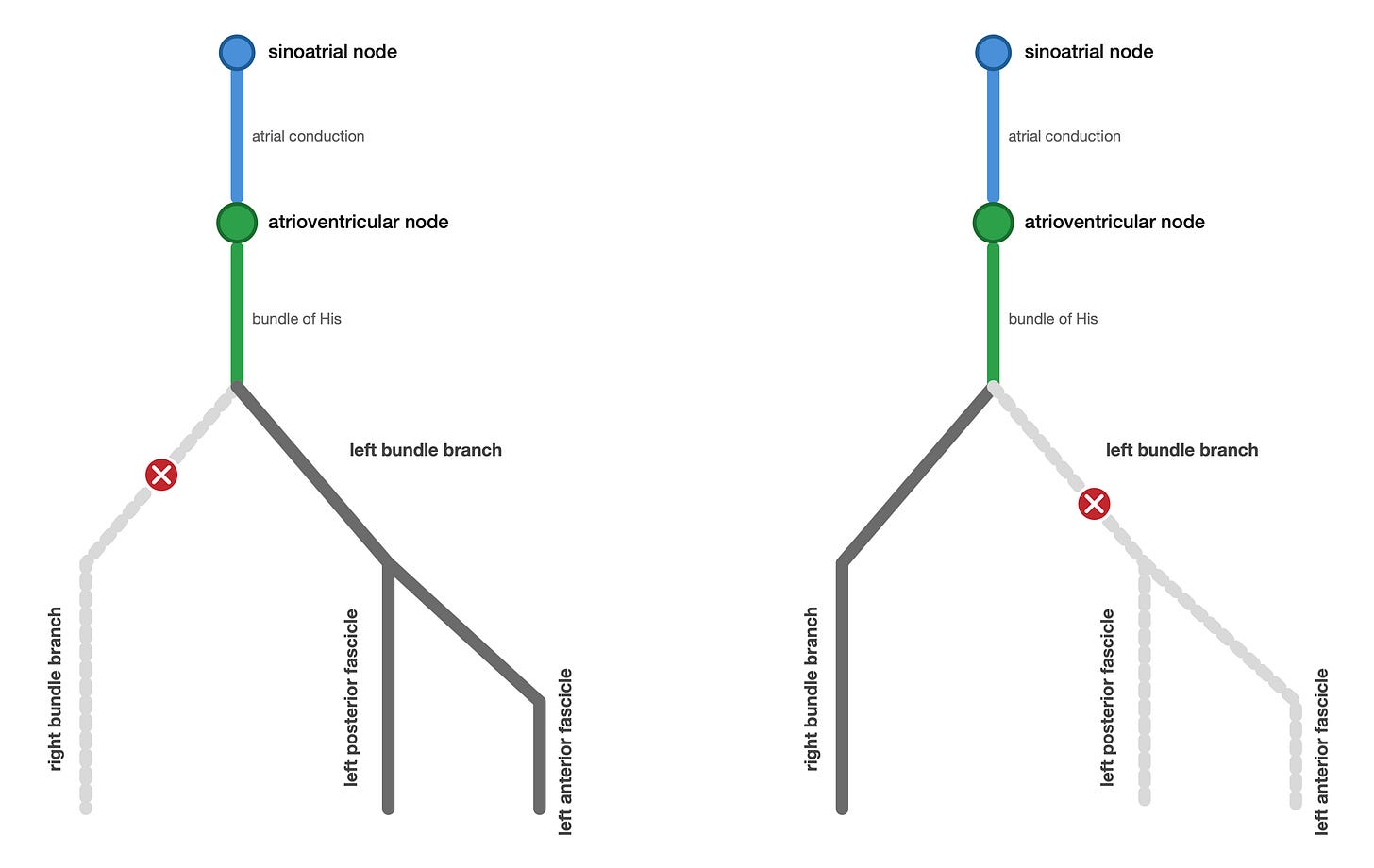 Side-by-side schematics of alternating bundle branch block: beat 1 with right bundle blocked, beat 2 with left bundle blocked (and both left fascicles downstream-blocked)