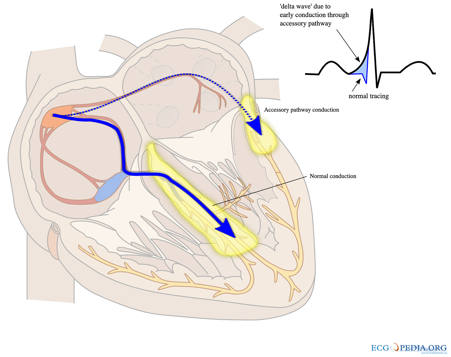 Cross-section of the heart showing two conduction routes from atria to ventricles: the normal pathway through the AV node and His-Purkinje system (solid blue arrow), and an accessory pathway bridging the atria and ventricles directly (dotted blue line). The accessory pathway activates ventricular muscle earlier, producing a slurred upstroke (delta wave) on the QRS complex, shown in the inset ECG tracing. Cross-section of the heart showing two conduction routes from atria to ventricles: the normal pathway through the AV node and His-Purkinje system (solid blue arrow), and an accessory pathway bridging the atria and ventricles directly (dotted blue line). The accessory pathway activates ventricular muscle earlier, producing a slurred upstroke (delta wave) on the QRS complex, shown in the inset ECG tracing.