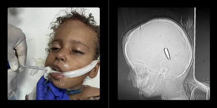 This Palestinian girl survived an Israeli bullet in the head\u2014a photo and X-ray image of her