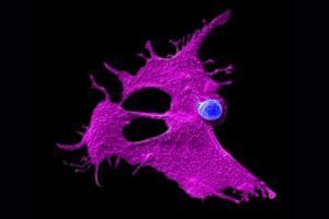 Microscopy image showing a stem cell-engineered CAR-NKT cell (blue) attacking a human solid tumor cell (magenta).
