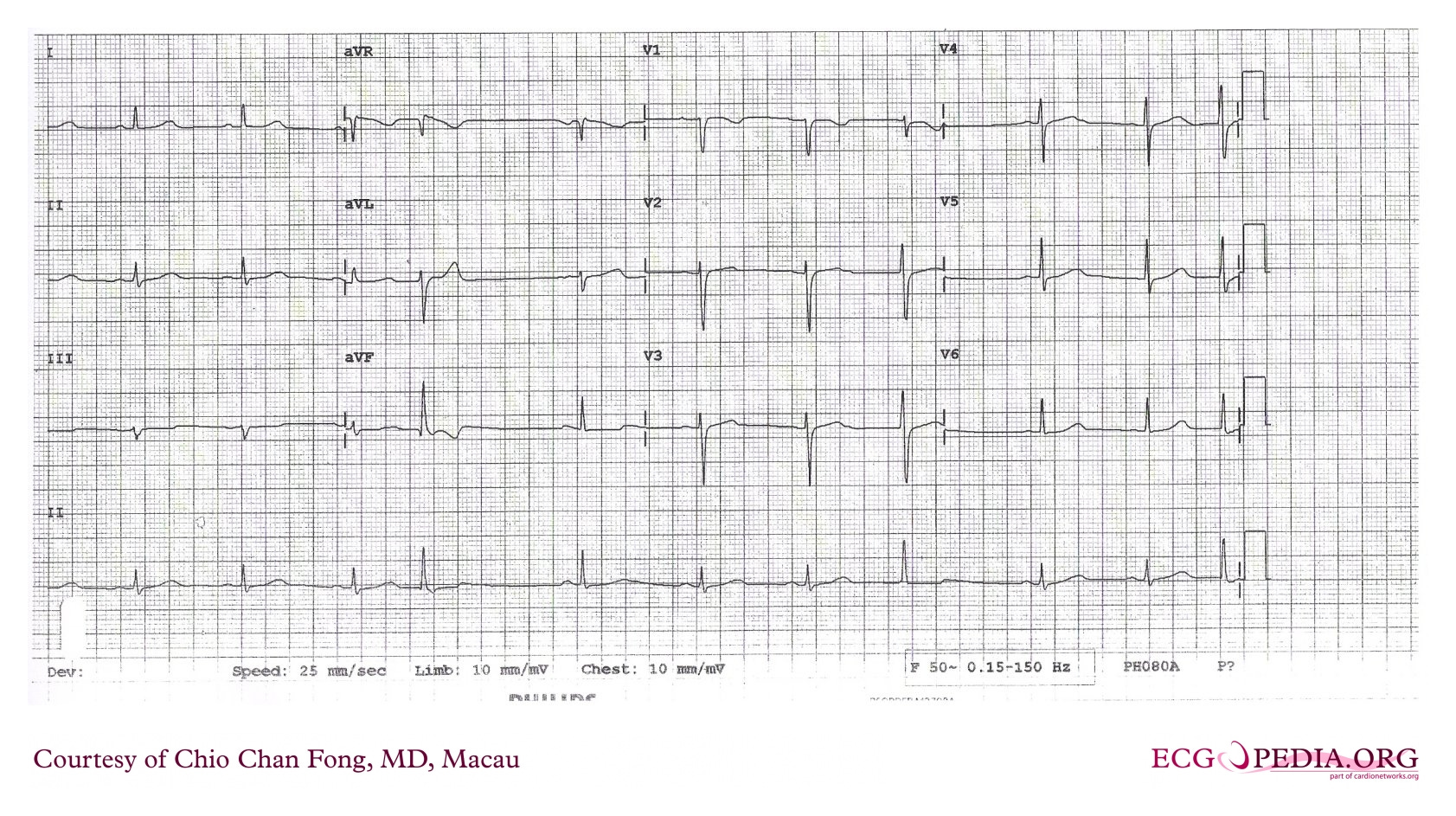 12-lead ECG with narrow QRS complexes and intermittent wider QRS complexes at varying intervals. 12-lead ECG with narrow QRS complexes and intermittent wider QRS complexes at varying intervals.