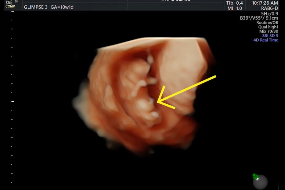 Groundbreaking ultrasound technnology offers a view into the womb. courtesy 