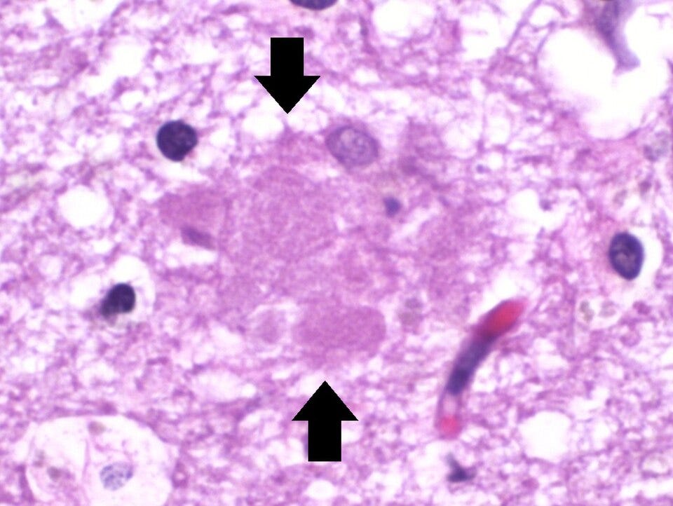 File:Histopathology of amyloid plaque in Alzheimer's disease - annotated.jpg