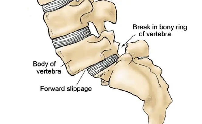 Spondylolisthesis - St. Louis Pain Consultants