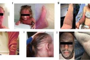 People affected by tsw