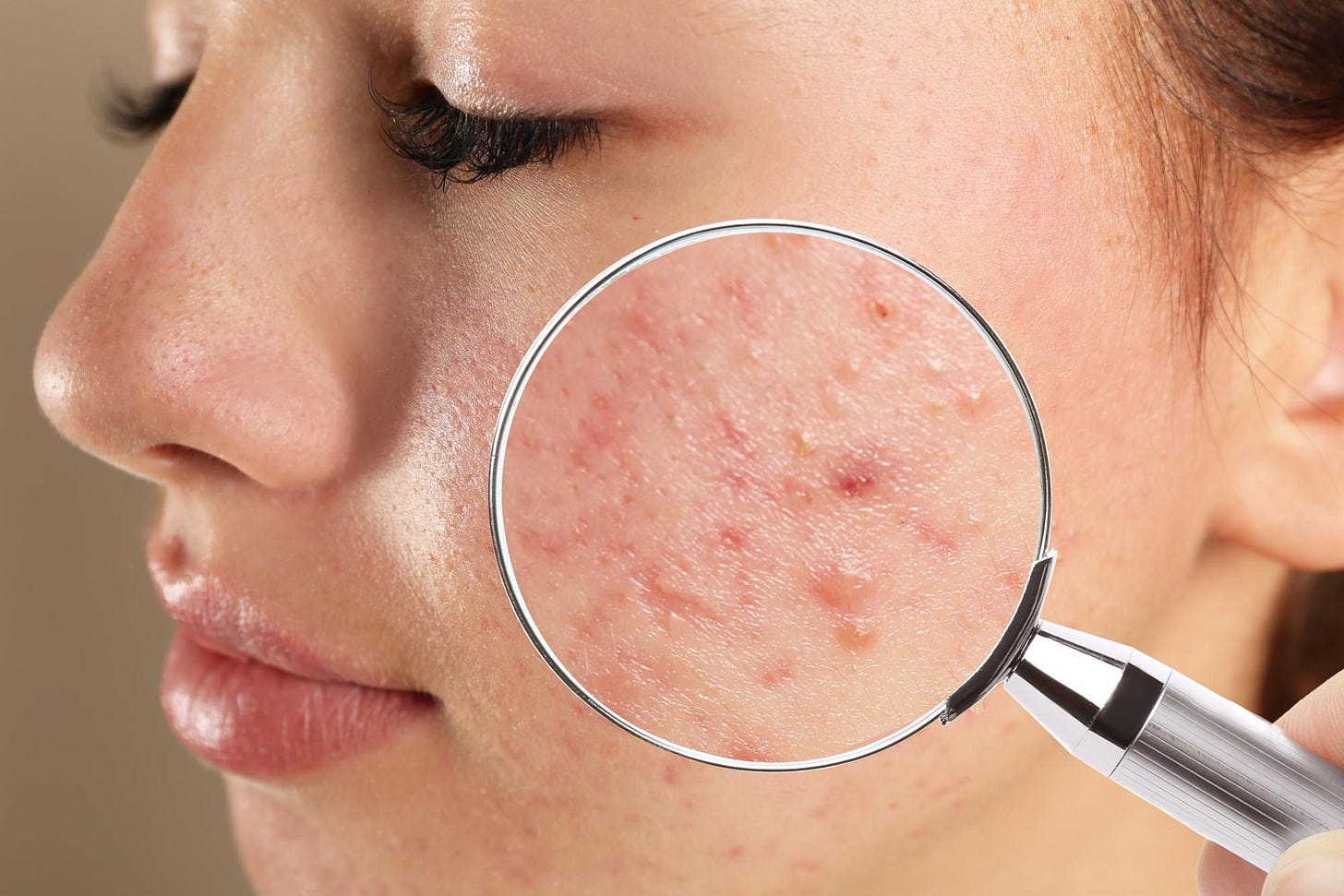 Engineered skin bacteria fight acne by producing common drug Engineered skin bacteria fight acne by producing common drug