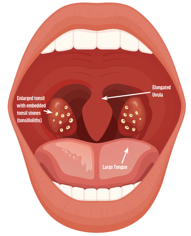 Tonsillectomy for the Treatment of Suspected Sleep Apnea with Subsequent Improvement of Chronic Migraine - Practical Neurology Tonsillectomy for the Treatment of Suspected Sleep Apnea with Subsequent Improvement of Chronic Migraine - Practical Neurology