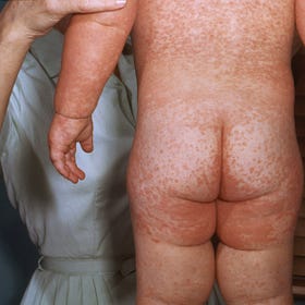 Measles is making a comeback. What does that mean for Los Alamos?