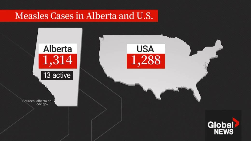 Alberta surpasses all of the United States in confirmed measles cases | Globalnews.ca Alberta surpasses all of the United States in confirmed measles cases | Globalnews.ca