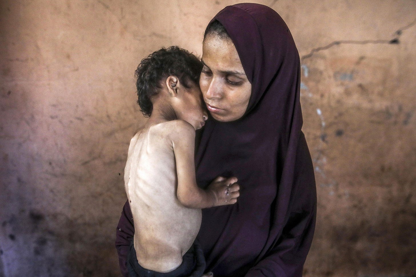 Yazan Abu Foul, di due anni, che soffre di grave malnutrizione, è detenuto da sua madre, nel campo profughi di Al-Shati, nella parte occidentale di Gaza City, il 19 luglio 2025. (Yousef Zaanoun/Attivestills) Yazan Abu Foul, di due anni, che soffre di grave malnutrizione, è detenuto da sua madre, nel campo profughi di Al-Shati, nella parte occidentale di Gaza City, il 19 luglio 2025. (Yousef Zaanoun/Attivestills)