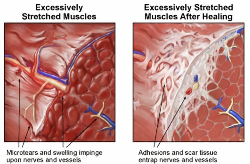 Scar Tissue Adhesions - Orca Massage Tools
