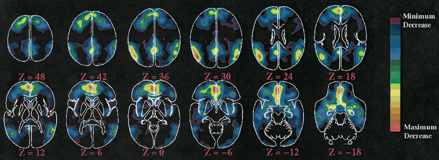 Figure 2. [Raichle et al. (2001)] Meta-analytical activations during attention demanding cognitive tasks.