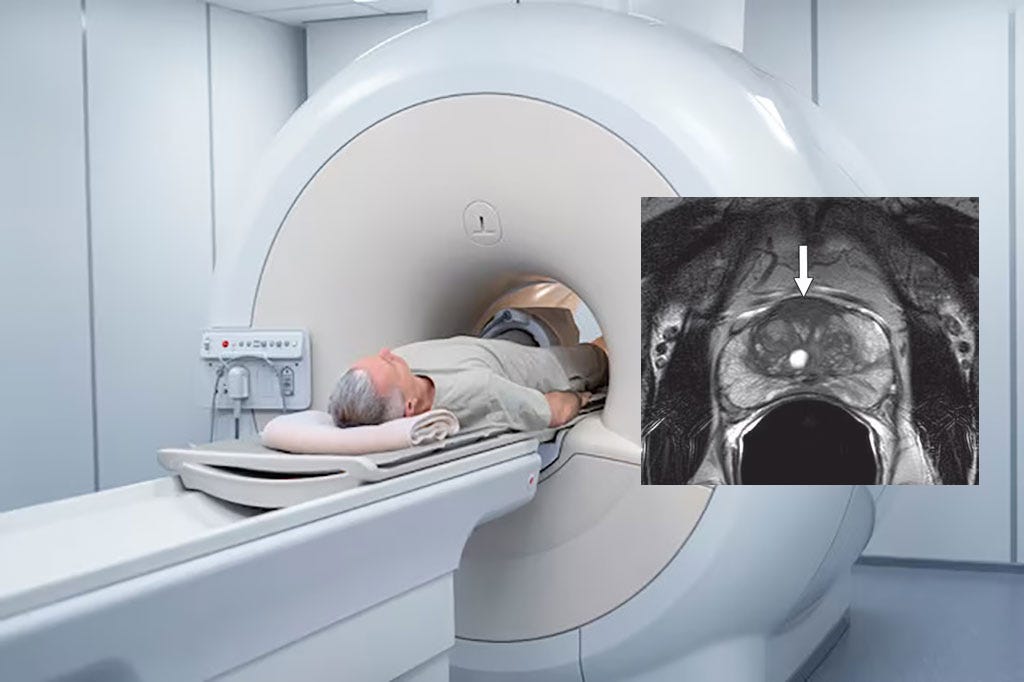 A patient undergoing MRI for prostate cancer detection