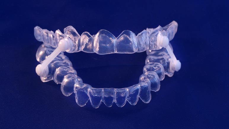 mouth guard for sleep apnea